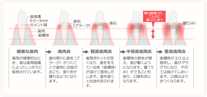 歯周病の進行